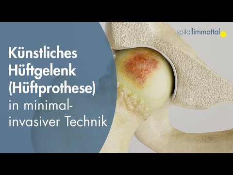 Immagine di anteprima: Articolazione artificiale dell'anca – sostituzione dell'articolazione dell'anca con tecnologia minimamente invasiva
